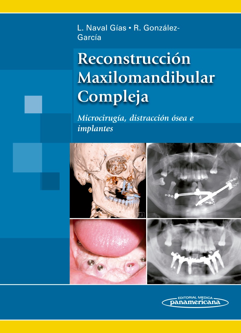 Reconstrucción Maxilomandibular Compleja Microcirugía, distracción ósea e implantes