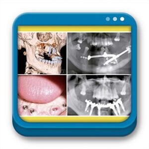Reconstrucción Maxilomandibular Compleja - Microcirugía, distracción ósea e implantes  - Luis Naval Gías,Raúl González-García