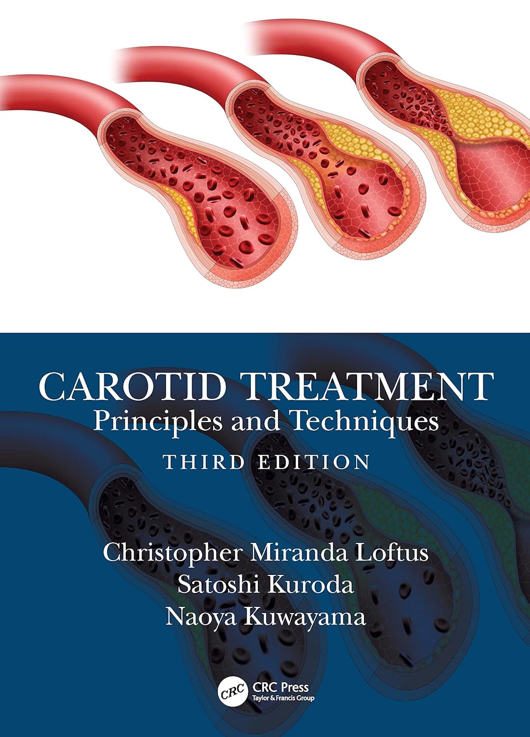 Carotid Treatment: Principles and Techniques By Christopher Miranda Loftus, Satoshi Kuroda, Naoya Kuwayama