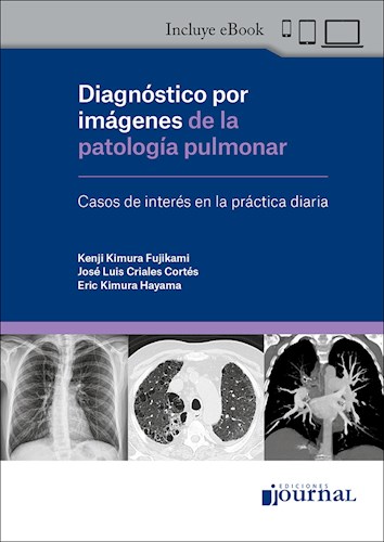 Diagnóstico por imágenes de la patología pulmonar 1 Edición - Autores: José Luis Criales Cortés, Kenji Kimura Fujikami,Eric Takehiro Kimura Hayama (copia)