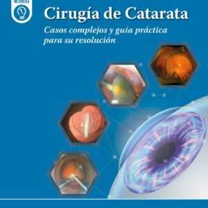 Cirugía de Catarata Casos complejos y guía práctica para su resolución / David Castillejos Ríos