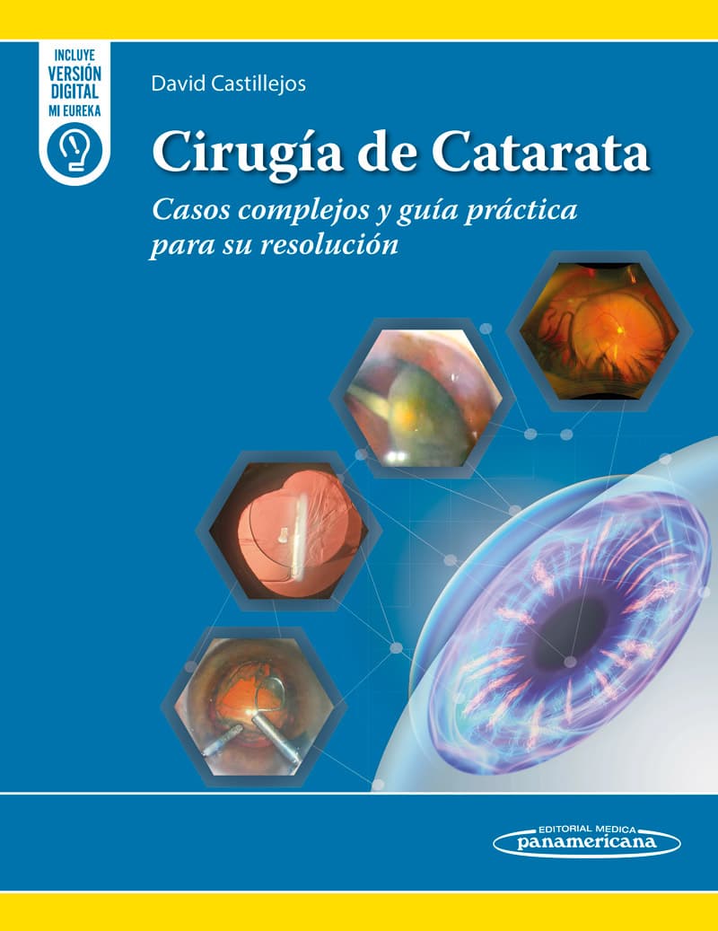 Cirugía de Catarata Casos complejos y guía práctica para su resolución / David Castillejos Ríos